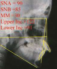SNA is 90, maxilla is placed forward